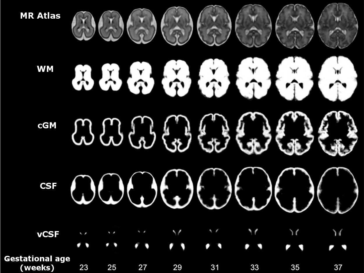 fetal brain MRI atlas