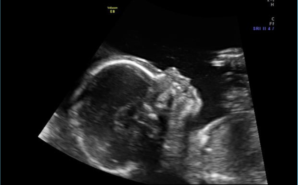 fetal MRI 2